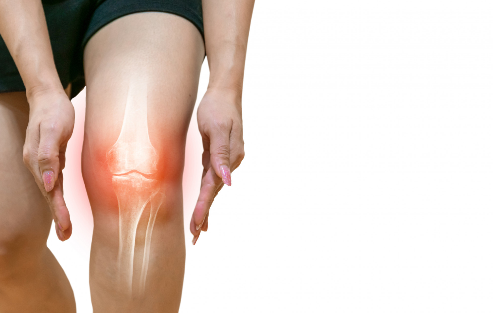 Osteoarthritis & Early Degeneration